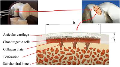 In silico evaluation of the mechanical stimulation effect on the regenerative rehabilitation for the articular cartilage local defects